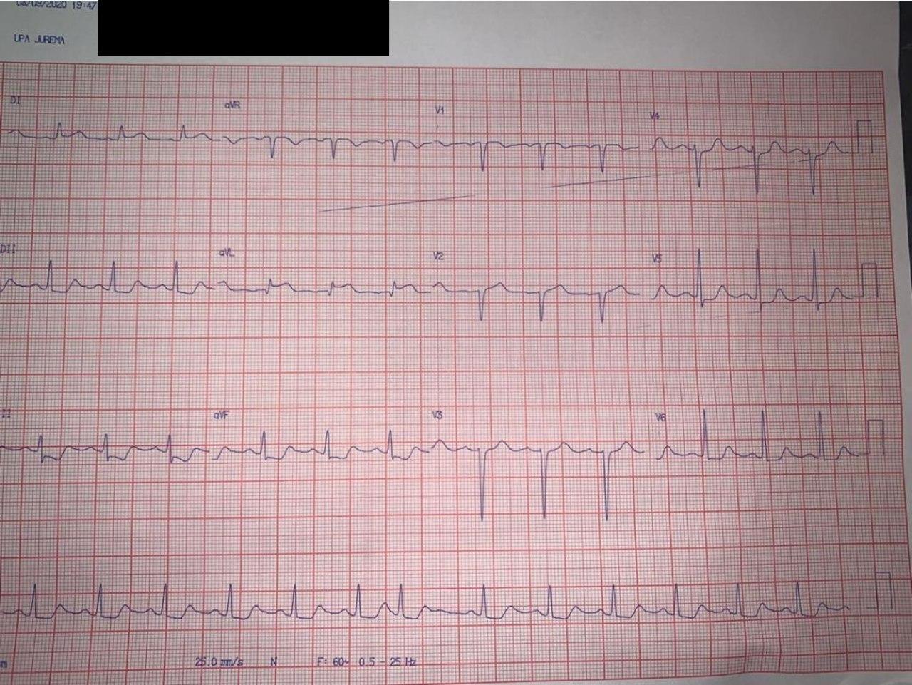 Paciente de 57 años con ángor prolongado por lesión en el tercio medio de la DA