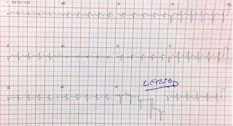 Paciente de 37 años que presenta síncope después de actividad física, que progresa a PCR, siendo resucitado con francos antecedentes familiares de MS, que presenta síndrome de Brugada
