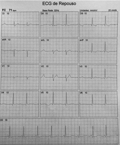 Paciente masculino de 57 años, HTA y dislipémico, que presenta fatiga ante esfuerzos, con ecocardiograma normal y detección de supradesnivel en aVR indicativo de lesión de TCI, lo cuál es corroborado por la CCG en la que se observa lesión de TCI + compromiso de 3 vasos
