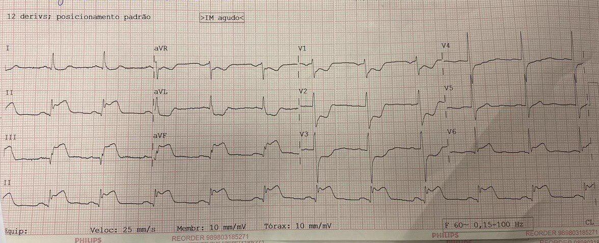 Paciente obeso de 43 años que cursa con dolor torácico con irradiación a dorso, parestesia de MMSS y sudoración profusa con cifras elevadas de TA que desarrolla TV con infradesnível del segmento ST en aVR que sugiere SCA por compromiso de Cx