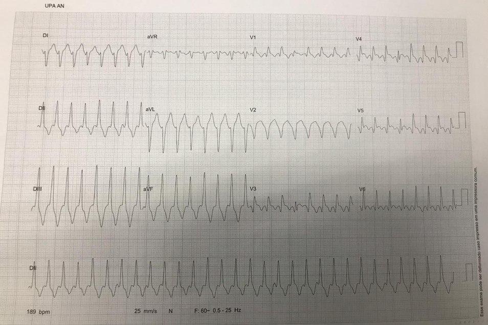 ECG de paciente de quién se carece de datos clínicos que presenta una TV fascicular anterior y una probable cicatriz de necrosis ánterolateral