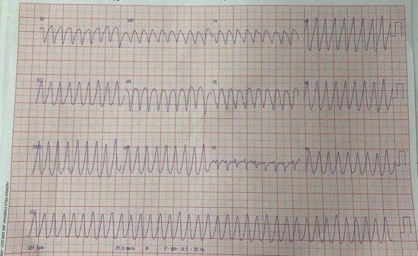 Paciente de 82 años, DBT tipo II que presenta síncope relacionado con la detección de TVMS que requiere CVE que logra restaurar ritmo sinusal con signo de Sgarbosa + y el hallazgo en la CCG de lesión de TCI y DA proximal con presencia de trombo