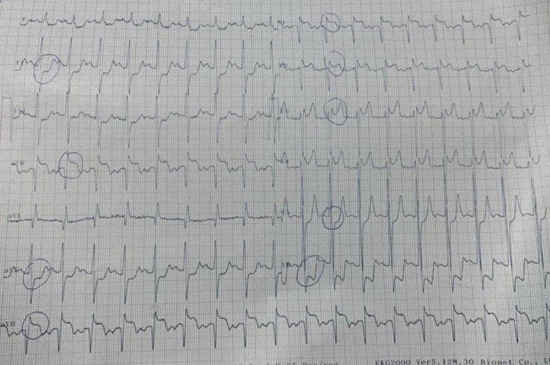 Mujer de 62 años, HTA y DBT con disnea progresiva de reciente comienzo, con muy baja saturación de O2 y congestión pulmonar, que presenta lesión crítica de TCI, lesiones severas en 1/3 medio de CD, 1/3 medio de DA y en bifurcación con rama diagonal, CX y rama MgI con lesiones severas