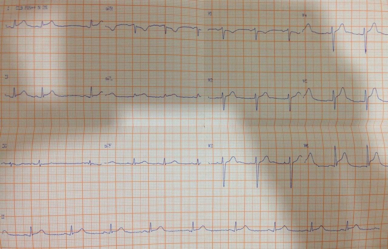 Hombre de 46 años que presenta factores de riesgo coronario y que manifiesta dolor precordial opresivo con elevación de troponina, cuya CCG muestra un puente miocárdico con compresión del 1/3 medio de la DA, a quién se realiza RNM en la que se observa edema miocárdico y signos difusos manifiestos de miocarditis