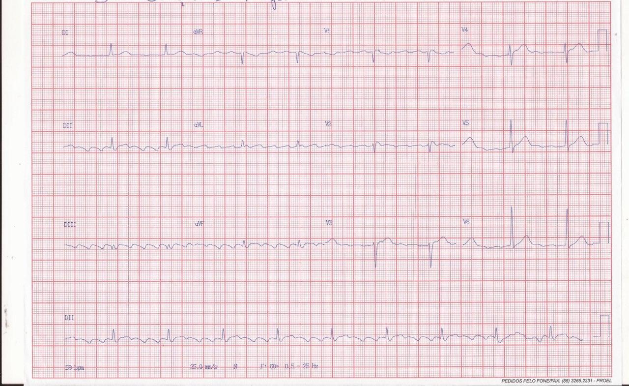 Joven de 23 años que presenta palpitaciones por AA 2:1 que requiere CVE, arritmia que recidiva recibiendo meses después una ARF que aumenta el grado de bloqueo AV desenmascarando un patrón de Brugada tipo I