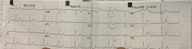 Mujer hipertensa con parestesias en brazos y piernas con ECG de ingreso normal que desarrolla BRI y ondas T negativas como expresión de memoria cardíaca