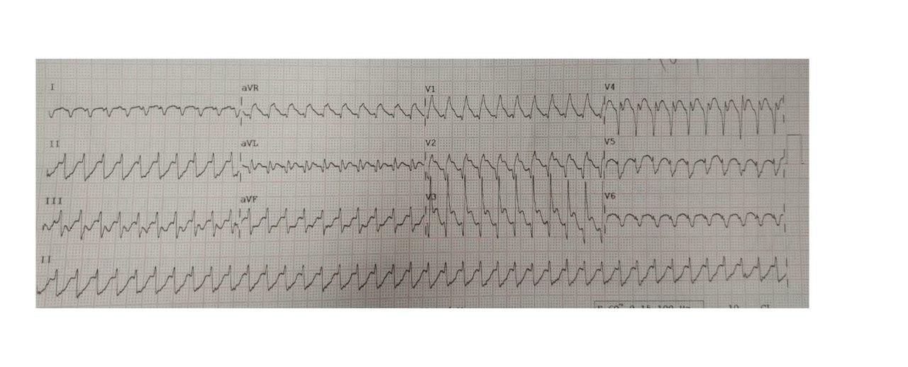 ECG de paciente que presenta palpitaciones e inestabilidad hemodinámica con antecedente reciente de implante de stent a DA y disquinesia, que muestra taquicardia de QRS ancho