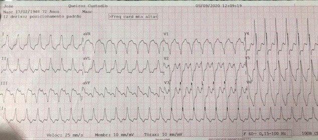 Varón de 72 años Ingresado en urgencias por taquicardia FC 170 y dolor epigástrico con antecedentes de infarto previo que corresponde a TV de origen subendocárdico