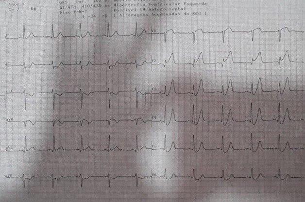 Hombre de 72 años que presenta ángor y el hallazgo ECG de patrón de Winter tipo II por oclusión proximal de la DA