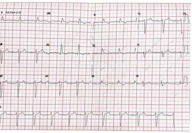 Hombre de 65 años con disnea progresiva durante 3 meses y presencia de soplo sistólico aórtico ++/4, que presenta bloqueo 3:2 tipo II por enfermedad de Lev