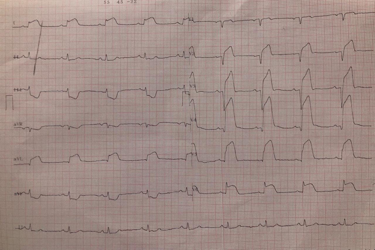 Hombre dislipémico de 62 años que presenta episodio severo de ángor prolongado que es tratado con trombolisis sin criterios de reperfusión en la DA y hallazgos angiográficos compatibles con rotura de placa más trombo con embolización distal después de la PCI