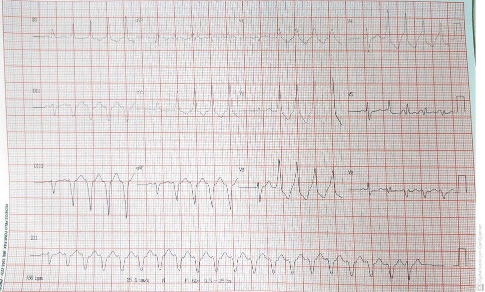 Hombre de 63 años con historia de síncope y dolor toráccico hacía unos meses que consultó por mareos, cuya CCG mostró obstrucción de DA 60% 1/3 medio, CD ocluida proximal, CX ocluida proximal, con signos de fibrosis de cara inferior, que desarrolla ráfagas de TVNS