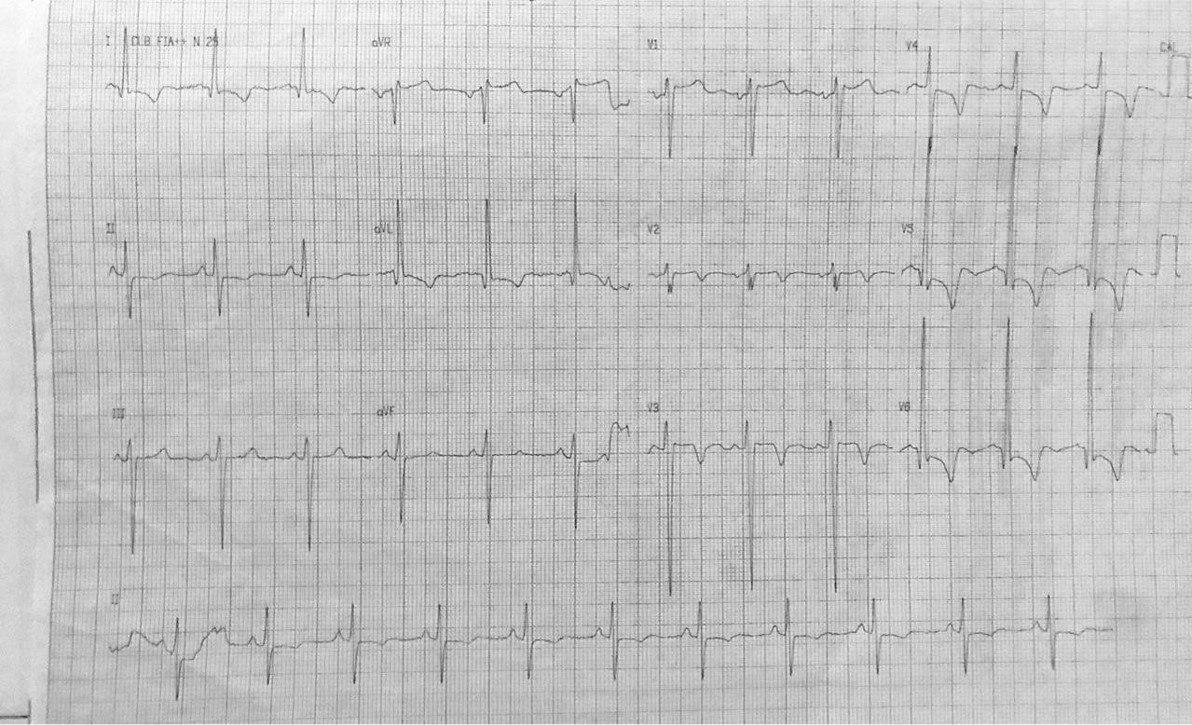 Varón de 55 años con dolor toráacico y disnea que presenta episodio sincopal ante esfuerzo con un patrón de «sospecha de isquemia subendocárdica circunferencial»