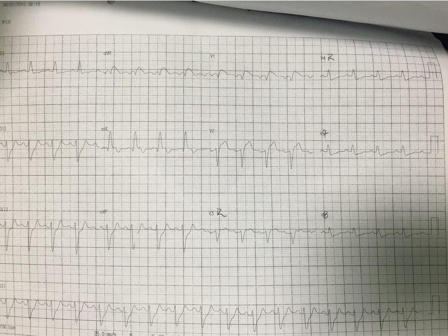 Paciente de 71 años, HTA y DBT con episodio de ángor prolongado en quién se constata oclusión total de TCI con circulación colateral desde la CD dominante, que lo mantiene vivo