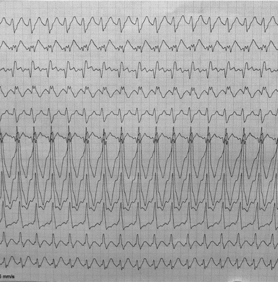 Trazado ECG correspondiente a un AA 2:1 preexcitado por una vía accesoria izquierda