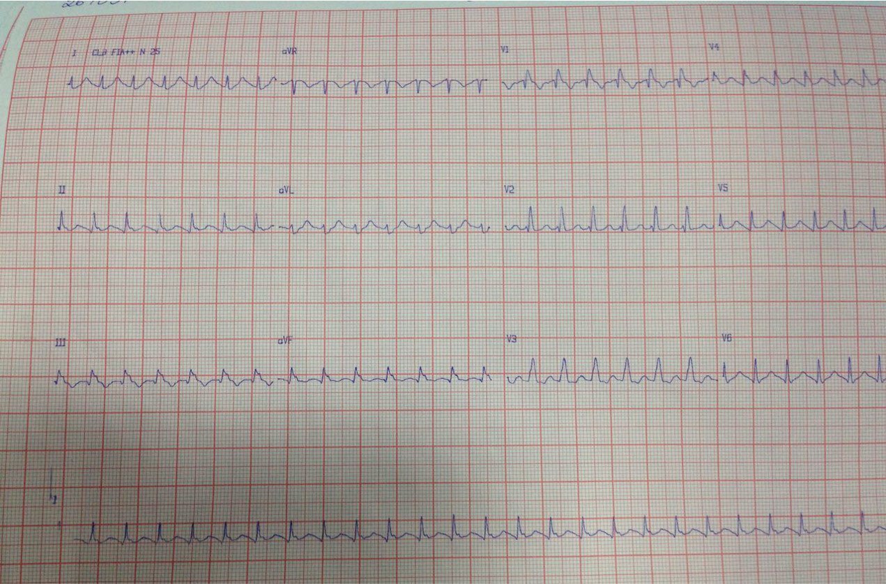 Trazado correspondiente a PO inmediato de trasplante cardíaco que presenta taquicardia de la unión AV que no responde a la adenosina y revierte espontáneamente