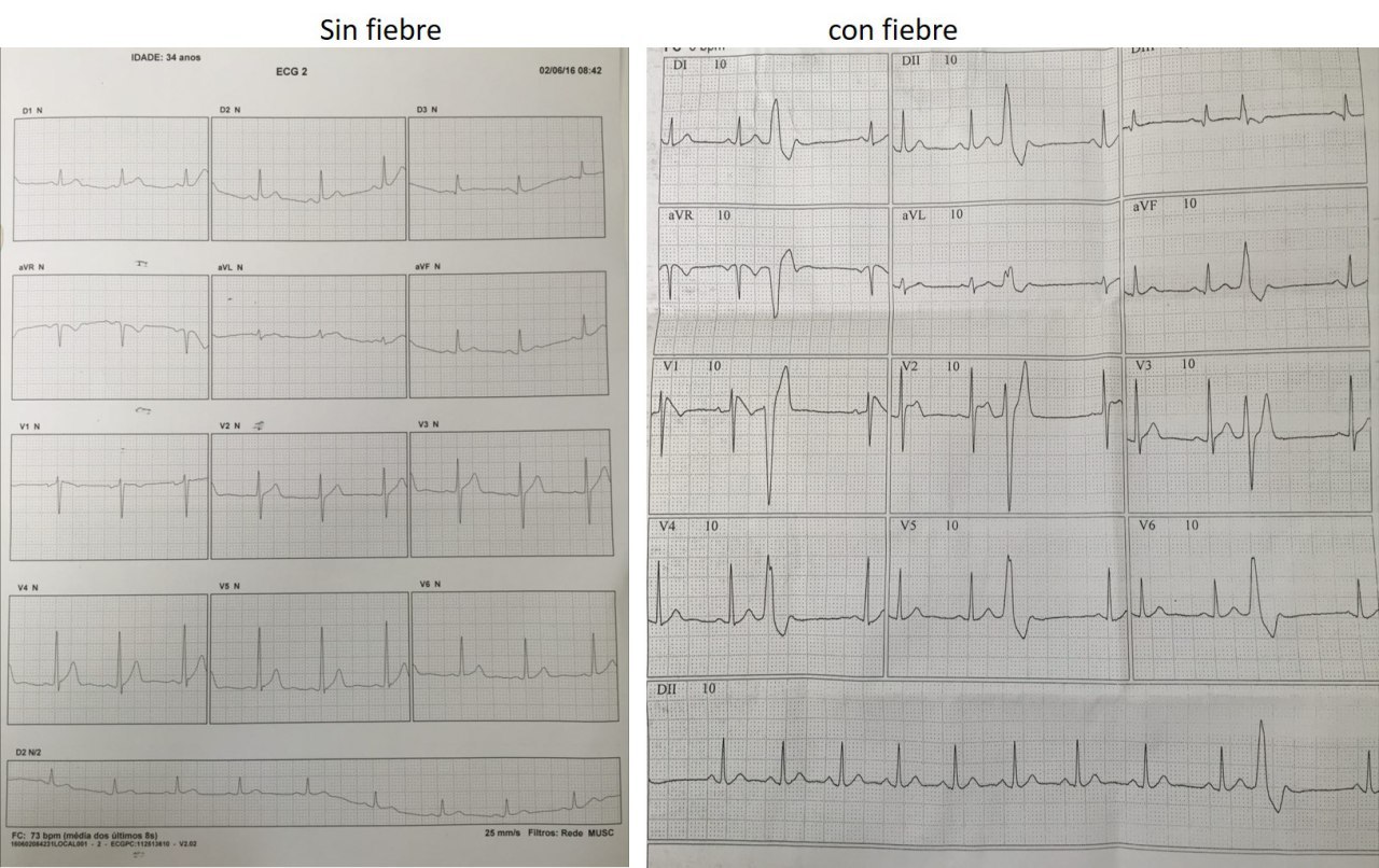 Paciente de 34 años sin antecedentes patológicos que durante un estado febril presentó intensas palpitaciones cuyo ECG muestra la presencia de síndrome de Brugada