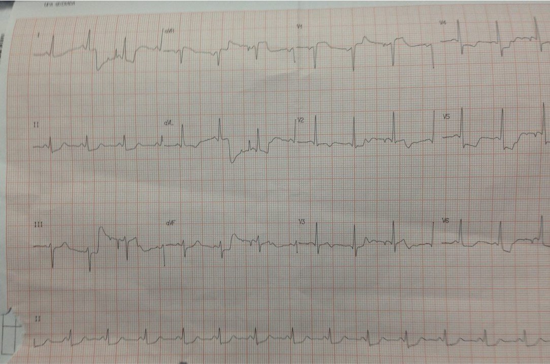 Hombre de 61 años con episodio de ángor que presenta supradesnivel ST en aVR + infradesnivel en V5 con T negativa por suboclusión de TCI