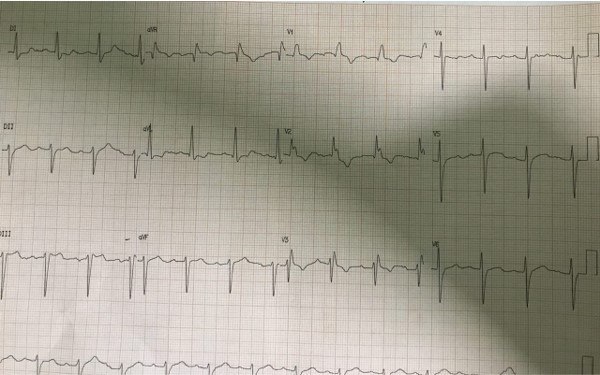 Paciente con antecedentes sincopales que presenta bloqueo trifascicular e imagen correspondiente a BIA