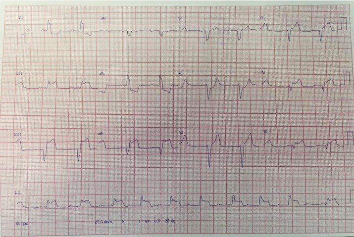 Paciente que cursa IAM de cara inferior con BAV 1º con EVs y ulterior evolución a BAVC con complejos de escape anchos «BCRI like» por compromiso de CD con trombo