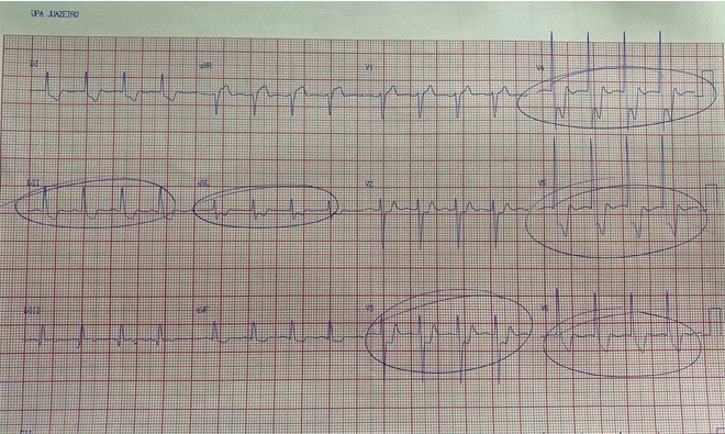 Paciente masculino de 67 años, HTA, portador de CA de estómago que presenta dolor precordial opresivo acompañado de sudoración y palidez
