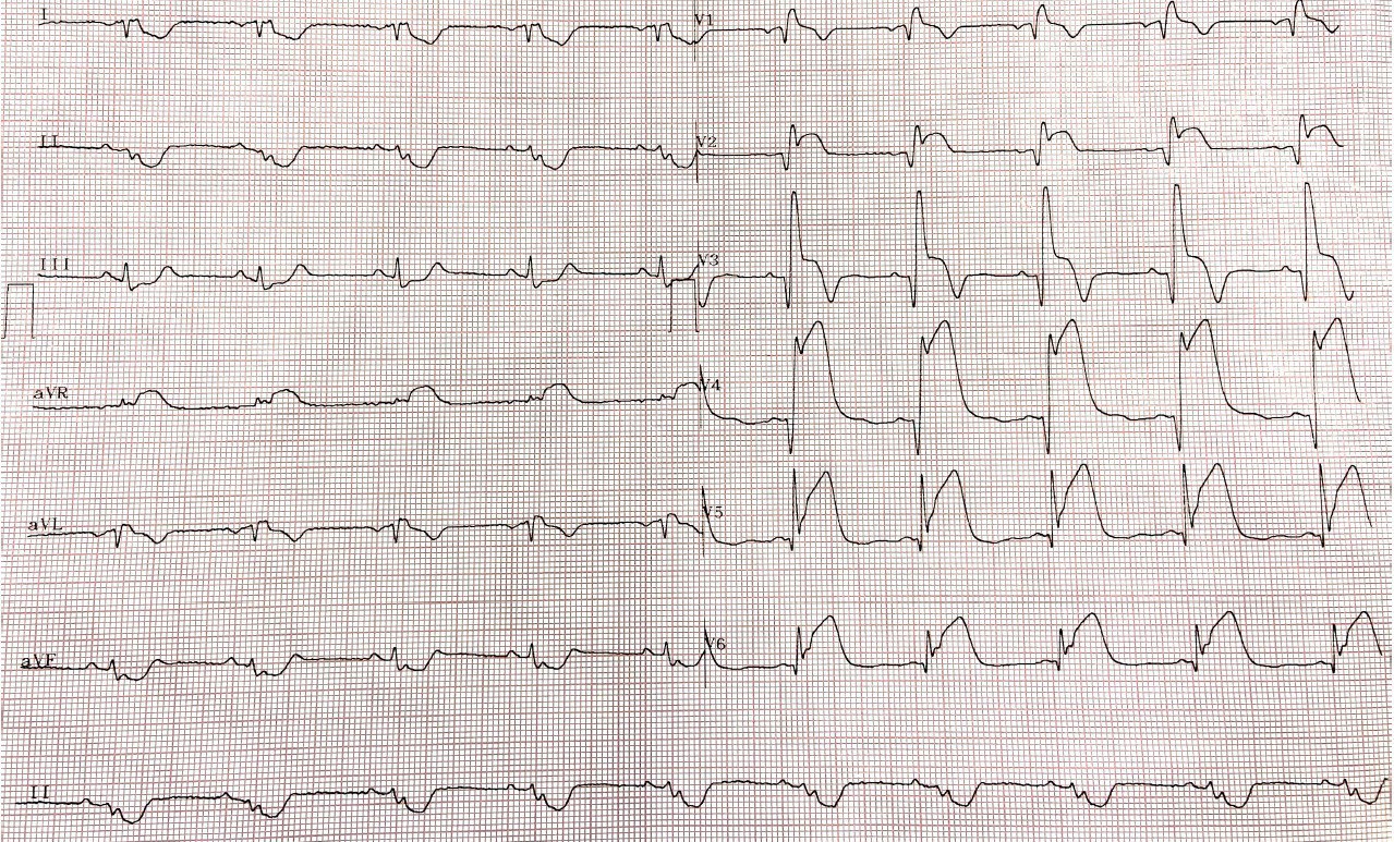 Paciente masculino de 60 años que presenta episodio intenso de ángor acompañado de disnea, sudoración y vómitos, cuyo ECG presenta inversion de electrodos de miembros superiores, que recibe tratamiento trombolítico constatándose a posteriori obstrucción de la DA proximal total + trombo realizándose angioplastia de rescate