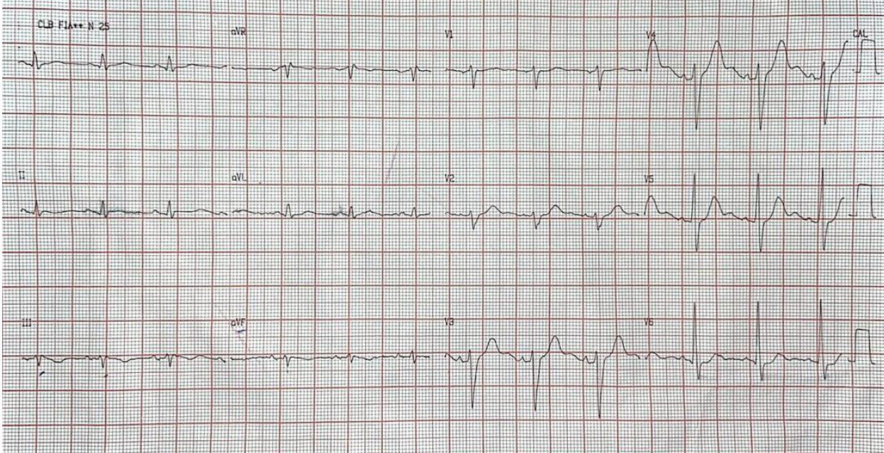 Paciente masculino de 67 años que presenta episodio de ángor intenso ante un esfuerzo que reitera al día siguiente constatándose en ECG isquemia de grado 1 correspondiendo a SCASEST por oclusión en 1/3 medio de Cx, 1º Marginal de gran importancia con lesión ostial del 90%