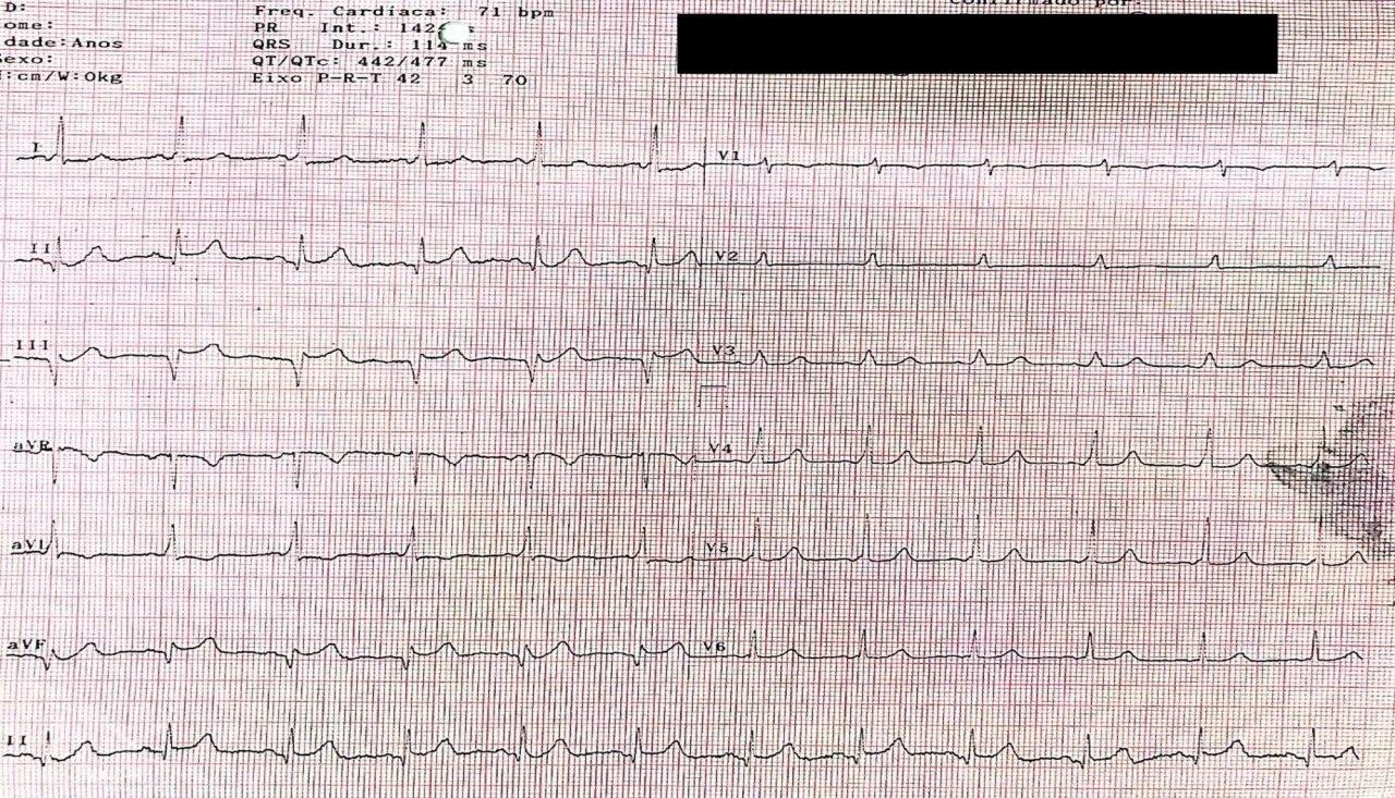 Mujer de 57 años que presenta dolor retroesternal e imagen ECG que simula IAM inferior por presencia de síndrome de Wolff Parkinson White