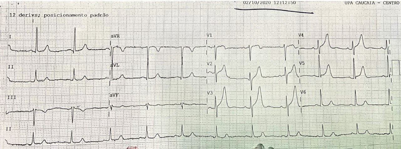 Hombre de 52 años que presenta episodio de ángor intenso ingresando con cuadro de SCA con BCRD constatándose lesión proximal del 90% de la DA y oclusión en tercio medio realizándose angioplastia con implante de dos stents liberadores de fármacos en la DA, exitosamente