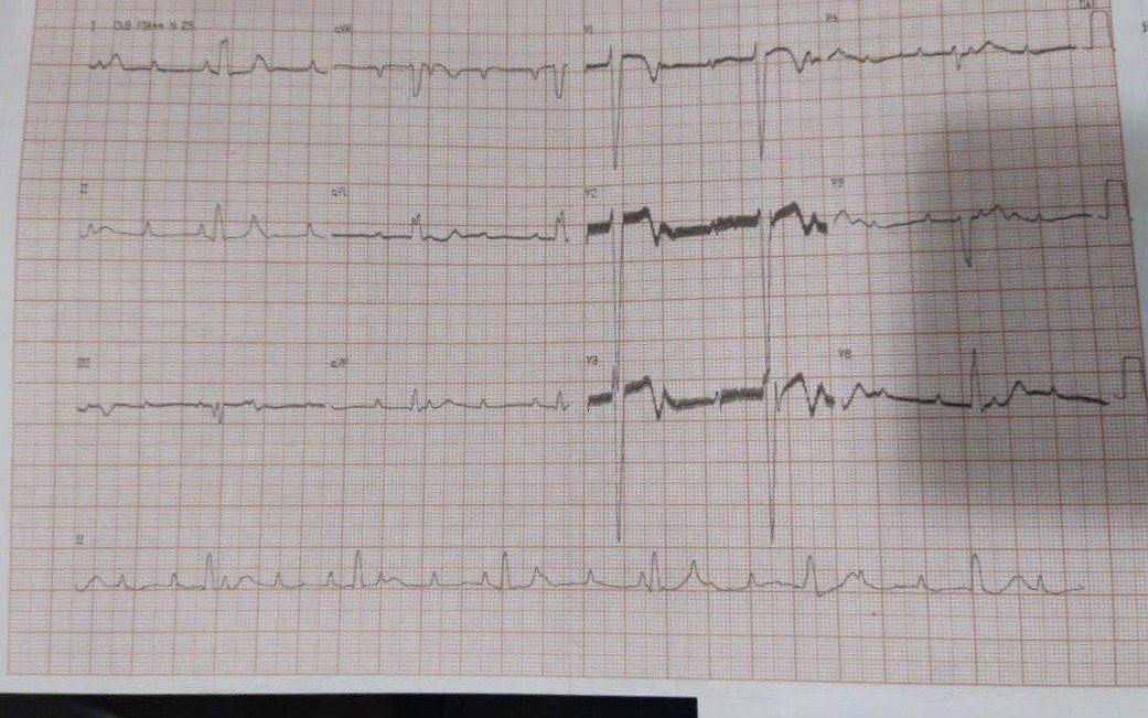 Niño 3 años, en post operatorio tardío de correción de CIV + Implante de MP definitivo, que se queja de mareos, cefaleas y episodios de «pérdida de conocimiento» con ausencia de espigas y BAVC en el ECG por umbral del electrodo ventricular extremadamente alto con alta impedancia por fractura del cable, lo cual consumió la batería y hubo un desgaste temprano