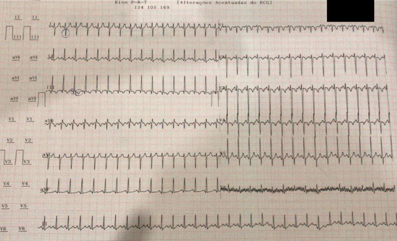 Hombre de 50 años con dolor precordial y troponina + que presenta TPSV y patrón S1Q3T3 por TEP, con detección de ondas T que se invierten en derivaciones precordiales,  que si también se invierten en las derivaciones III y V1, la embolia pulmonar es mucho más probable que el SCA