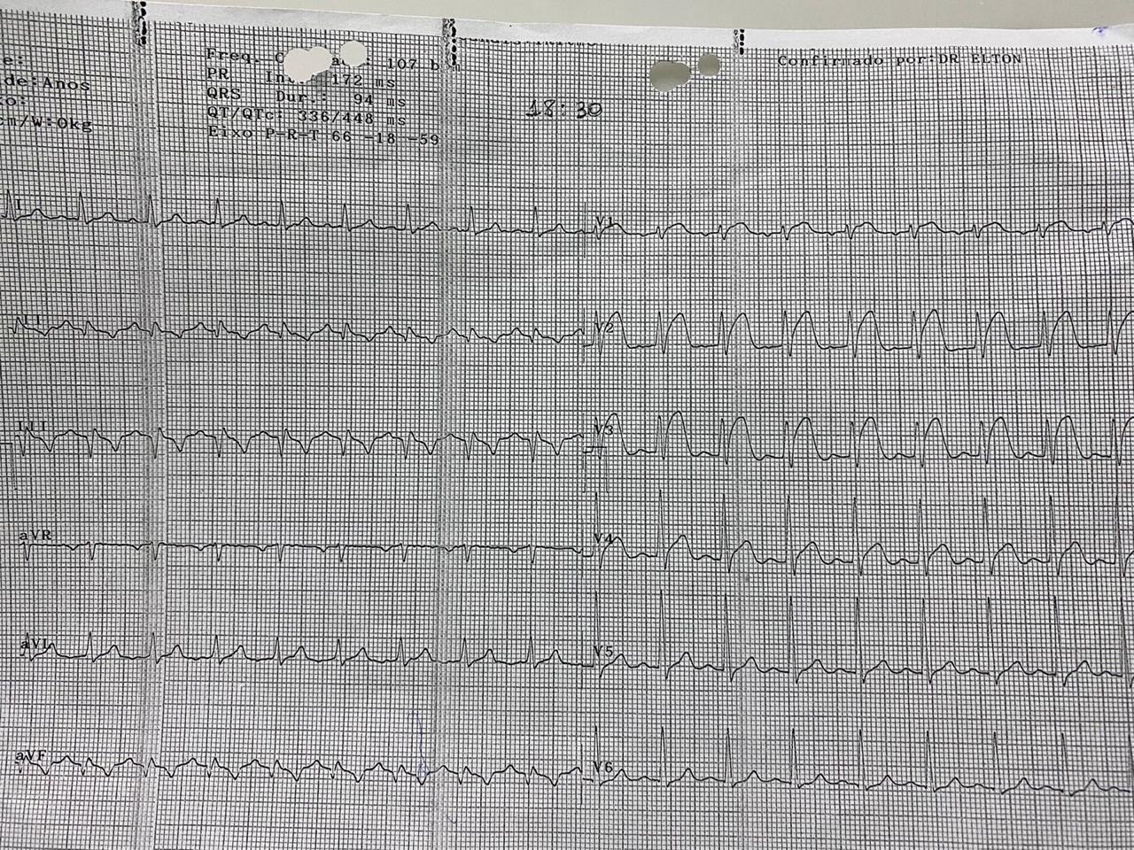 ECG de paciente con SCA realizado tras tratamiento con angioplastia e implante de stent en CD constatándose compromiso de VD