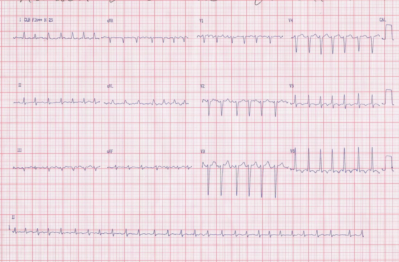 Hombre de 27 años con una larga historia de disnea, con FA por presencia de miocardiopatía dilatada secuela post miocarditis