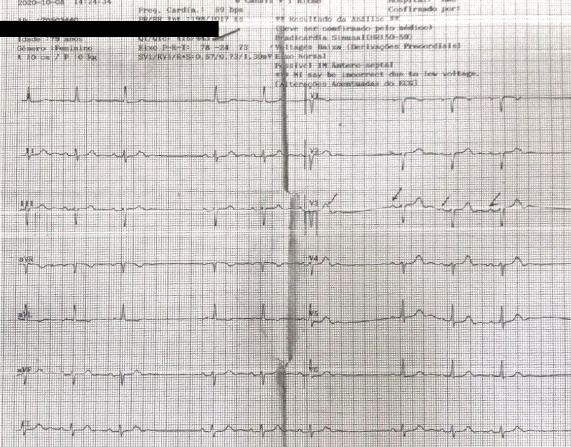 Mujer de 74 años, HTA y DM2 en uso de amiodarona, con  mareos y bradicardia que ingresa para evaluar indicación de marcapasos que presenta ESV conducidas, algunas con aberramcia de RD y otras bloqueadas, constituyendo una bigeminia auricular bloqueada, simulando bloqueo AV