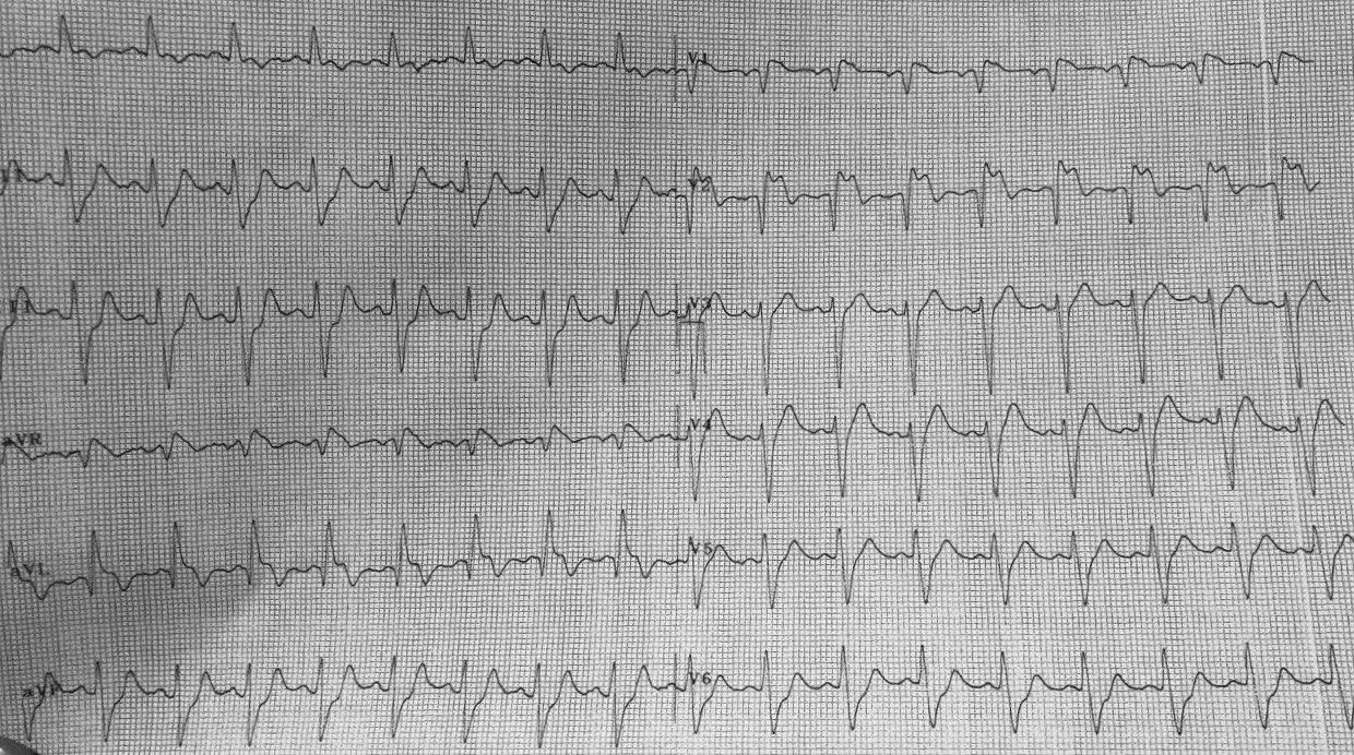 Paciente de 63 años, DM2 que presenta dolor precordial opresivo, con EV y duplas, con SCACEST por compromiso de TCI