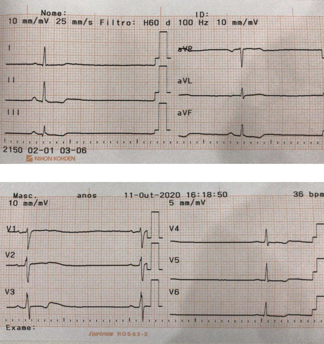 Paciente que en intento de suicidio ingiere distintos medicamentos presentando severa bradicardia sinusal con signos de impregación digitálica