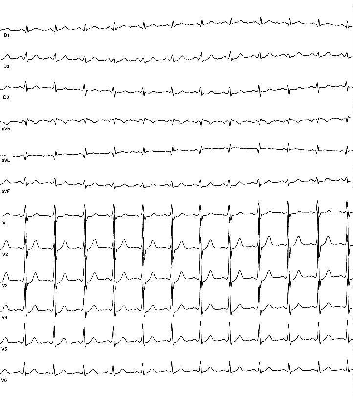 Paciente de 62 años, que presenta dos episodios de síncope sin pródromos que presenta una preexcitación mínima sugestiva del haz accesorio lateral izquierdo (DI Y aVL delta negativo)