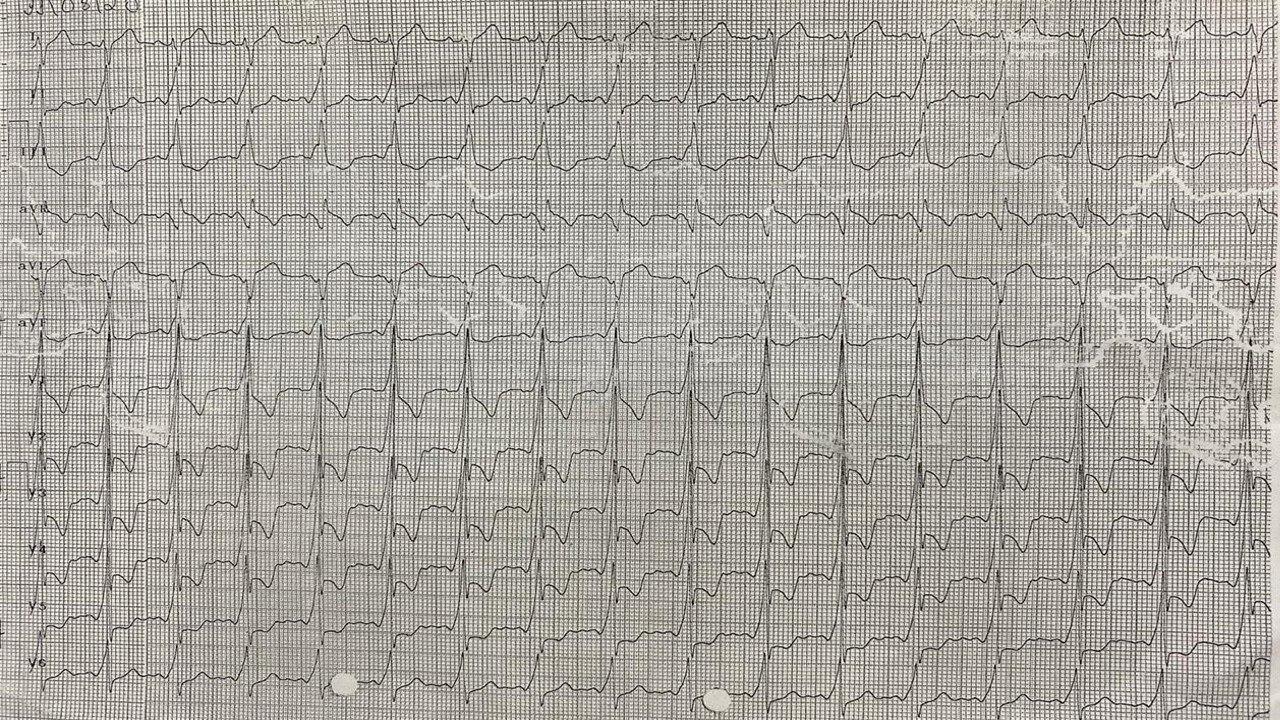 Hombre de 36 años que a posteriori de consumo de cocaína presenta episodio de ángor acompañado de palpitaciones y síntomas neurovegetativos en cuyo ECG se observan signos compatibles con SCA y probable existencia de vía accesoria y que en la CCG se constata puente intramiocárdico sobre la DA
