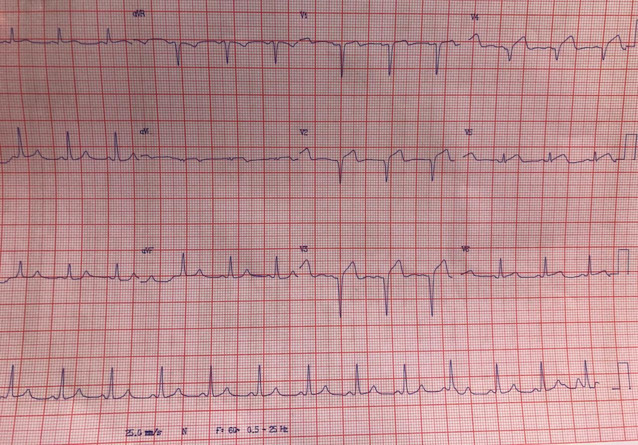 Paciente de 38 años con antecedentes familiares de enfermedad coronaria que presenta episodio de ángor prolongado con imagen de IAM anterior en evolución por oclusión con trombo de la DA proximal y 40% de la 1º diagonal con circulación colateral desde la CD a la DA