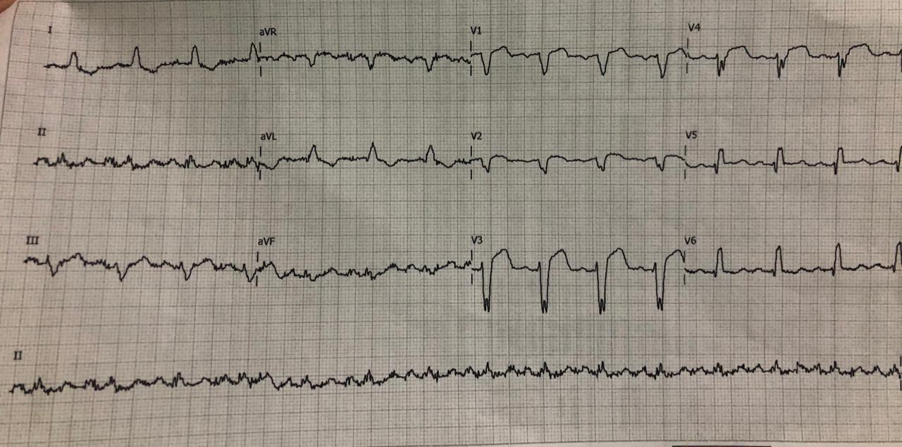 Hombre de 74 años con múltiples factores de riesgo que presenta episodio de ángor cuyo ECG muestra ritmo de MP que alterna con ritmo sinusal por compromiso de la DA proximal y suboclusión de la rama Diagonal