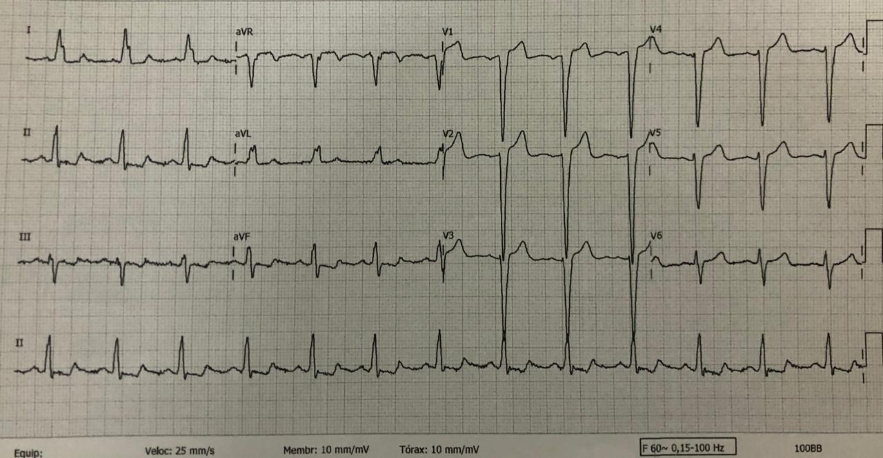 Mujer de 65 años, HTA y dislipémica que arrastra dolor mandibular desde hace meses y que presenta intenso dolor precordial cuya CCG muestra puente intramiocárdico en la DA con  redución  significativa de la luz arterial