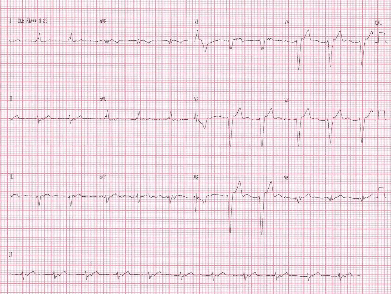 Paciente implantado con un marcapasos en modo VVIR por bloqueo AV completo que 3 semanas después retornó  sintomático por disnea y malestar en cuello que presenta retroconducción 1:1 a las aurículas realizándose “upgrade” a modo DDD con resolución de los síntomas