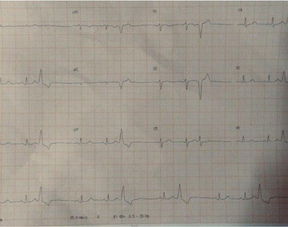 Mujer de 39 años con palpitaciones y disnea que presenta EV muy frecuentes en ausencia de cardiopatía