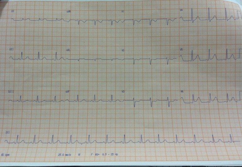 Mujer de 67 años, HTA y DM2 que presenta episodio de ángor inicialmente interpretado como SCASEST, recibió angioplastia con retraso aunque realmente presenta ST elevado en DI, aVL y depresión en V1-V3 por oclusión de la Cx