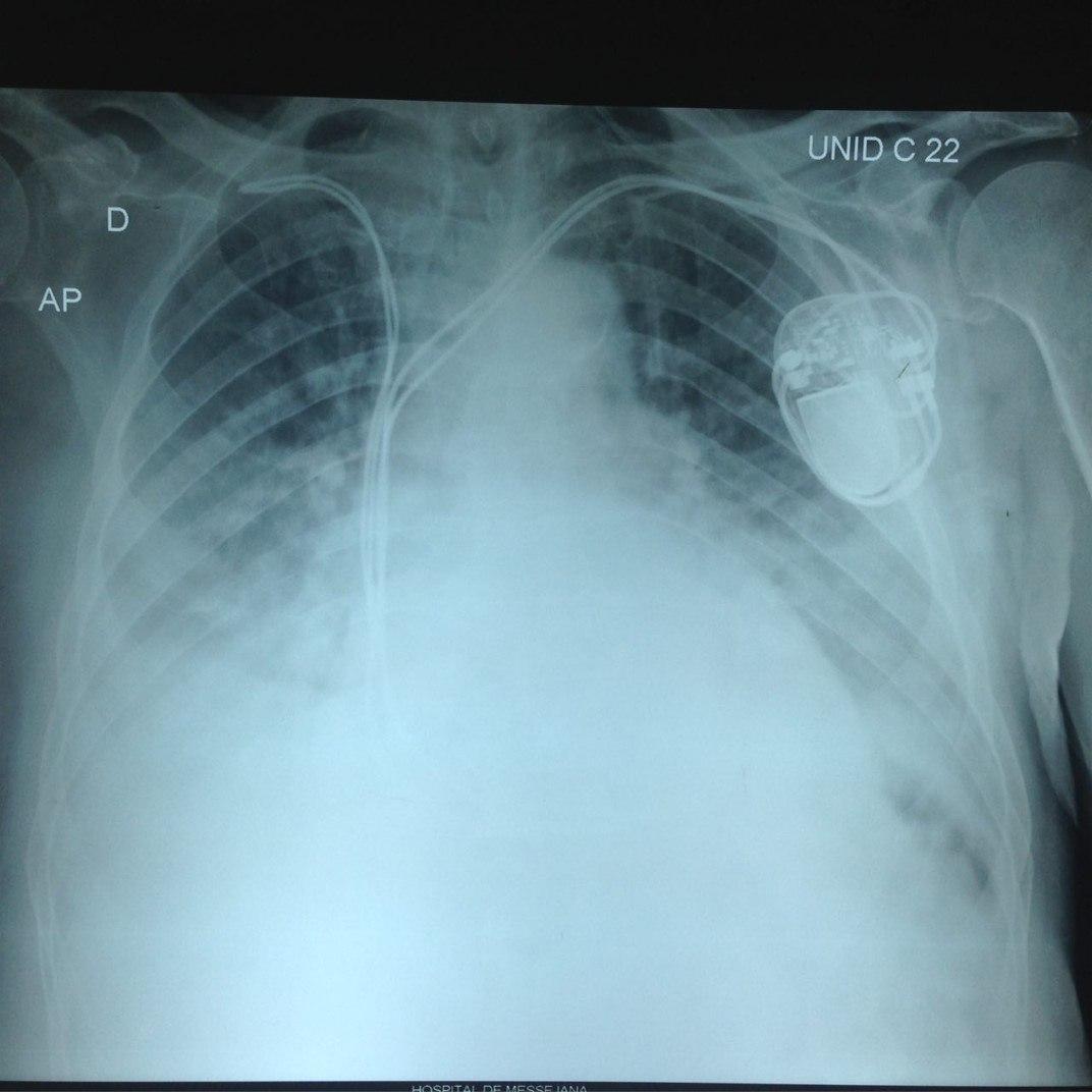 Paciente de 81 años portador de marcapasos con IC refractaria por estenosis aórtica + disfunción severo del VI  a quién se practica valvuloplastia con posterior indicación de TRC