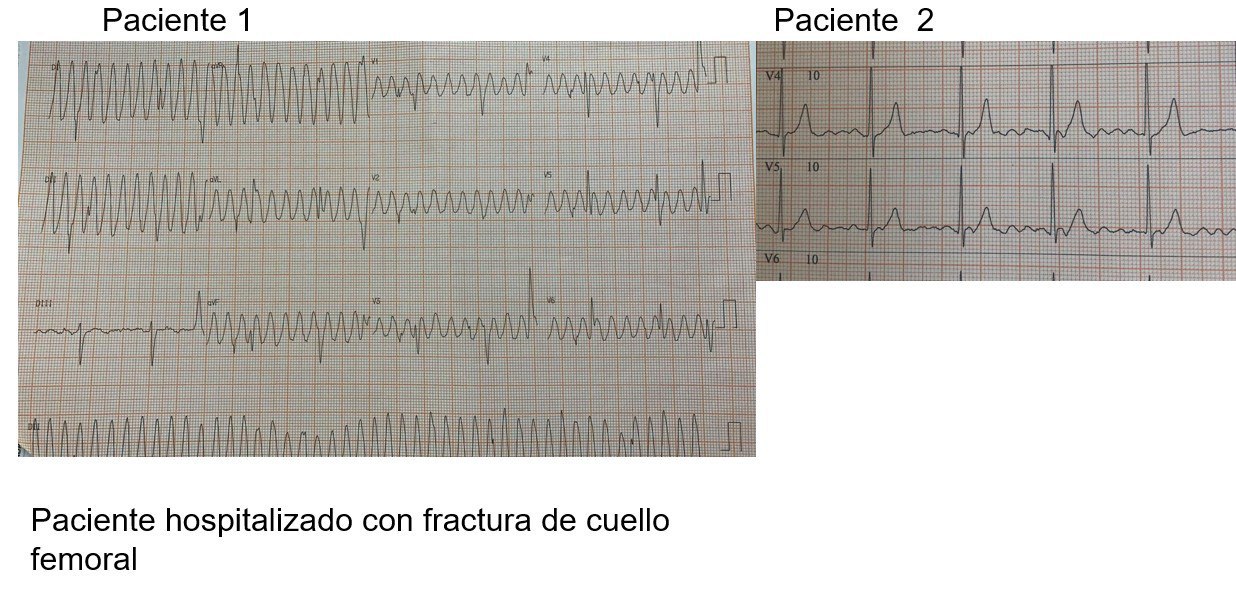 Trazados correspondientes a dos pacientes portadores de Enfermedad de Parkinson