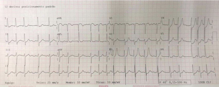 Paciente de 65 años, hipertenso, obeso y dislipidémico que presenta dolor retroesternal y disnea súbita seguido de pérdida del conocimiento ingresando con un patrón ECG de Winter con T positiva en V5 y evolución ulterior al paro cardio respiratorio irreversible