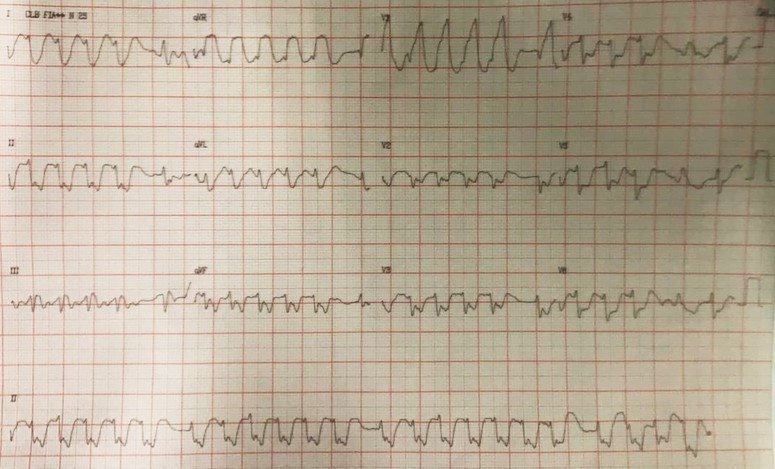 Paciente chagásico de 76 años con intoxicación digitálica, acidosis e hiperpotasemia que presenta disnea, palpitaciones y episodio sincopal por FA con manifiesta aberrancia que revierte al corregir el medio interno, a ritmo de la unión