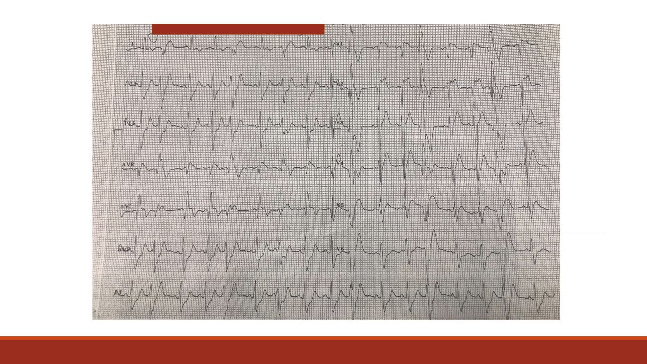 Paciente masculino de 63 años con dolor precordial con irradiación a dorso y disnea post esfuerzo en quién se constata oclusión total crónica de TCI con circulación colateral de grado III desde CD