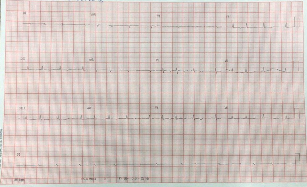Mujer de 45 años con disnea y anasarca por presencia de miocardiopatía restrictiva debida a endomiocardiofibrosis